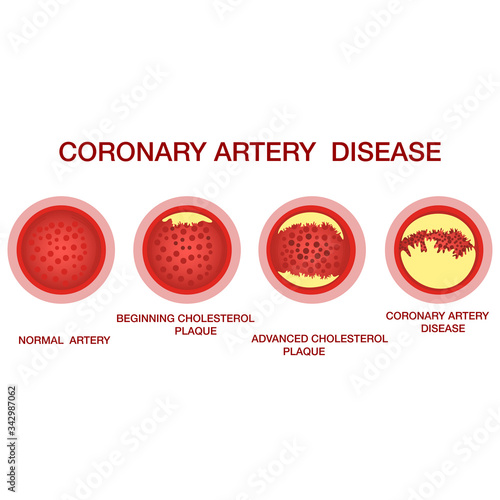 Coronary artery disease concept. Healthy and narrowed arteries with ...