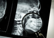 
Man's jaw on x-ray, close-up view through a magnifier