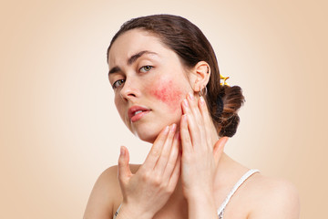 Portrait of a young pretty Caucasian woman who frowns and shows reddened and inflamed cheeks. Beige background.The concept of rosacea, healthcare and couperose