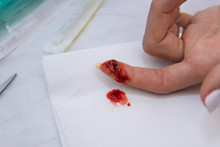 Schnittwunde Finger Mit Blut