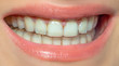 women smile with invisible braces orthodontic removable aligners