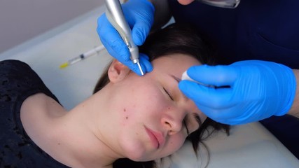 Wall Mural - Surgeon removing mole using laser on woman face, burning skin, beauty treatment, closeup view. Cosmetic treatment in beauty clinic. One day surgery concept. Removing birthmark surgical procedure.