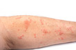 Skin disease rash on a man arm