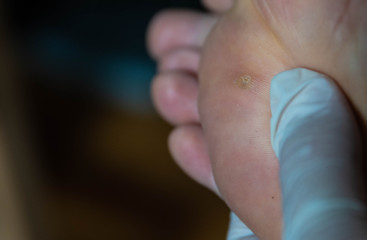 Close up shot of a warty Caucasian man's foot. The fingers of the hand inspect the skin near the infected area.