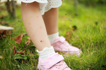 cute asian little girl has skin rash and allergy from mosquito bite and sucking blood at legs while playing on green grass field outdoor