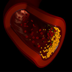 3d Illustration of a Vein With Cholesterol Formation Top View