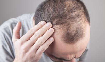 Caucasian man checking his hair. Hair loss problem