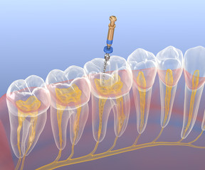 Endodontic root canal treatment process. Medically accurate tooth 3D illustration.