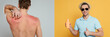 Collage of sunburnt man with red skin on back on grey background and man showing bottle of sunscreen and like sign on yellow background, panoramic shot