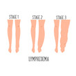 Lymphedema stages. Lymphatic system disfunction. Elephantiasis, legs swelling disease.