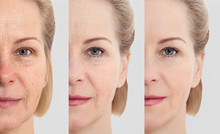 Face Without Makeup. Middle Age Close Up Woman Face Before After Cosmetic. Skin Care For Wrinkled Face. Before-after Anti-aging Facelift Treatment. Facial Skincare And Contouring.