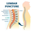 Lumbar puncture vector illustration. Labeled spine structure procedure scheme