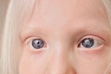 close-up photo of albino child eyes, little girl with unusual eyes, hair, eyebrows and lashes color. natural beauty, albinism concept