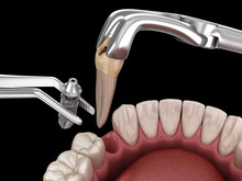 Extraction And Implantation, Complex Immediate Surgery. Medically Accurate 3D Illustration Of Dental Treatment