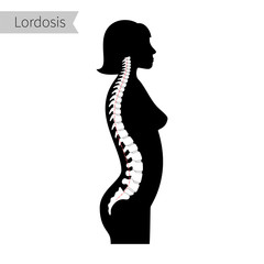 Wall Mural - lordosis flat vector illustration.