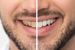 © Proxima Studio - Teeth before and after whitening