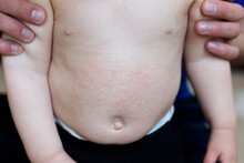Abdomen Of A One Year Old With Atopic Dermatitis (Eczema), Showing A Red Rash And Excoriations From Scratching