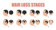 Hair loss stages vector isolated. Male alopecia