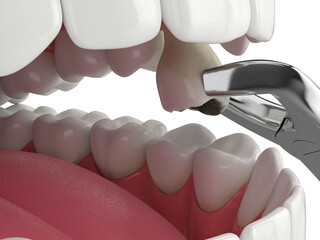 Wall Mural - 3d render of lower jaw with tooth extraction