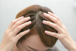 Dandruff and greasy hair on the head of a young female. Unhealthy head skin