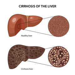 Wall Mural - Cirrhosis of the liver. Histology of the healthy and cirrhotic liver with corresponding labels. Anatomical vector illustration in flat style isolated over white background.