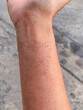 closeup dried rash of allergic contact dermatitis on forearm skin