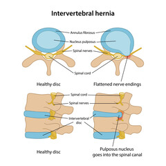 Wall Mural - Intervertebral hernia with main description. Healthy disc and disc with intervertebral hernia in superior and lateral views are isolated on white background. Vector illustration in flat style