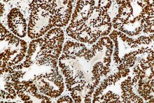 Adenocarcinoma Of The Endometrium With Strong Nuclear Expression Of The Mismatch Repair Protein Called MSH2. Microscopic View.