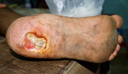 Chronic diabetic foot ulcer at the bottom of foot in Southeast Asian, Myanmar male patient. Wound debris present and slightly granulated. Ulcer with Punched out edge.