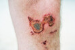 Close up of red scab injury on man knee background
