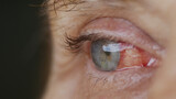 Fototapeta  - close up. woman eye with burst capillaries, cataract surgery.