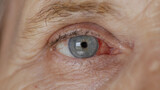 Fototapeta  - close up. elderly woman eye with burst capillaries, cataract surgery.