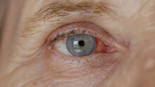 Close Up. Elderly Woman Eye With Burst Capillaries, Cataract Surgery.