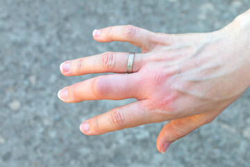 right hand with a swollen large middle finger after a bee bite with a wedding ring, enlarged in size due to allergy reaction after a wasp sting, red sensation on palm, finger wounded, skin irritation