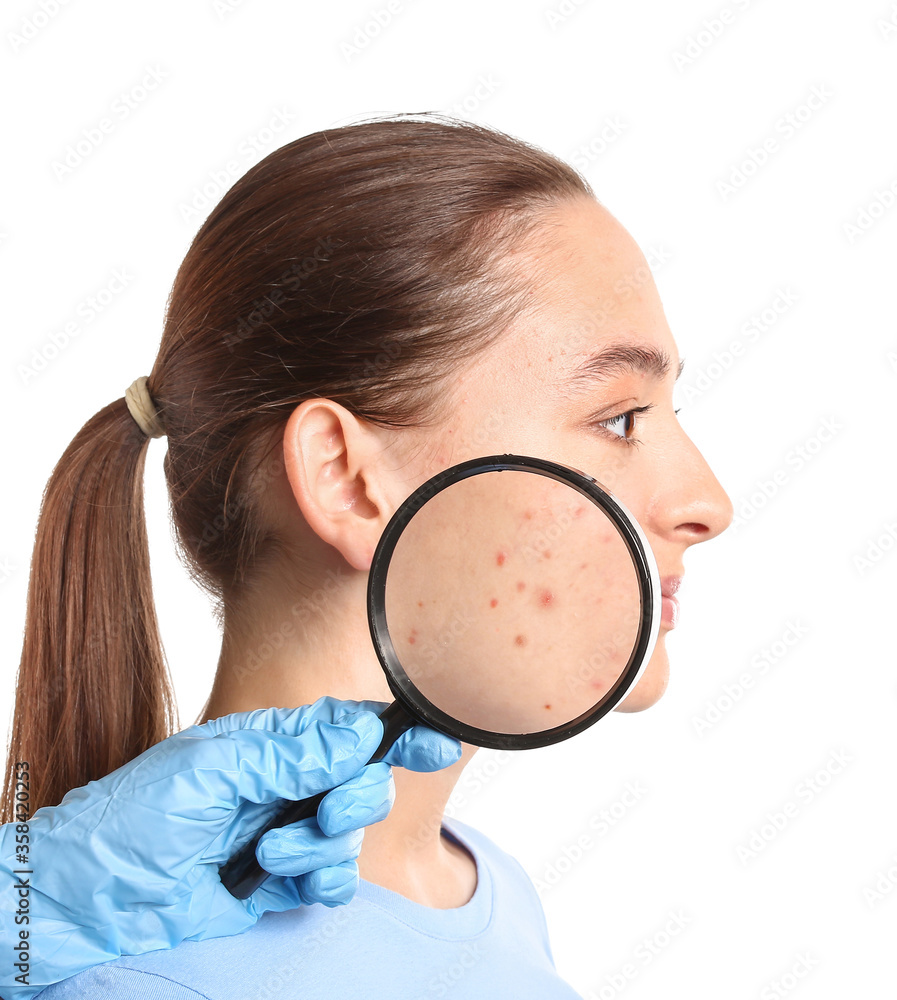Young woman with acne problem and doctor's hand with magnifier on white background
