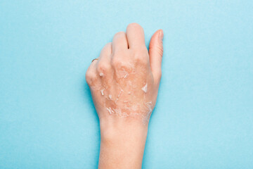 cropped view of female hand with dry, exfoliated skin on blue