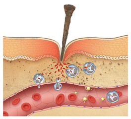 Inflammation is a process by which white blood cells protect of the body from infection with bacteria and viruses