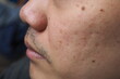 © TS.PHOTOS - Closeup of red skin with acne black moles and pores on the face of a young Asian man. Health, medical, beauty, aesthetics concept