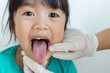 asian child has geographic tongue and was check by doctor