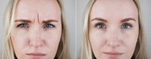 Photos Before And After Mesotherapy, Biorevitalization, Botulinum Toxin Injections. Skin Fold Between Eyebrows, Forehead Wrinkles. At The Appointment With A Plastic Surgeon Or Cosmetologist