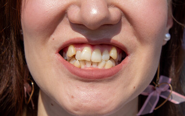 Curved female teeth, before installing braces. Close - up of teeth before treatment by an orthodontist