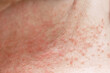 Skin disease prickly heat rash or miliaria on belly skin of woman. Healthcare skin cause for outdoor work in sunny with hot weather and have sweat. Dermatologist and treatment medication concept.