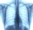 © utah51 - Lung Chest x-ray images