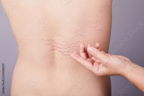 Close up view of the hand holding a drop of transparent gel on the young pearson\'s back with striae distensae (striae rubrae) background. The concept of impaired skin elasticity during puberty