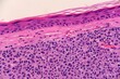 A malignant skin cancer called nodular melanoma, just beneath the epidermis. Microscopic view.