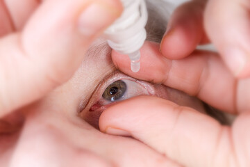 Human eye during the dripping with eye drops, close-up