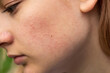 © Анастасія Стягайло - Problematic skin. Acne and red festering pimples on the face of a young girl. Facials for teen girls. Skin care concept.