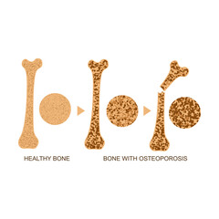 Canvas Print - Osteoporosis Bone Infographics Concept Card Poster. Vector