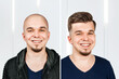 Man before and after transplant hair and alopecia