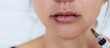 © Elena Trufanova - Plastic lips. Women's lips after injections of hyaluronic acid. Complications after lip augmentation, close-up scars and bruises. The concept of cosmetic plastic surgery of the lips.